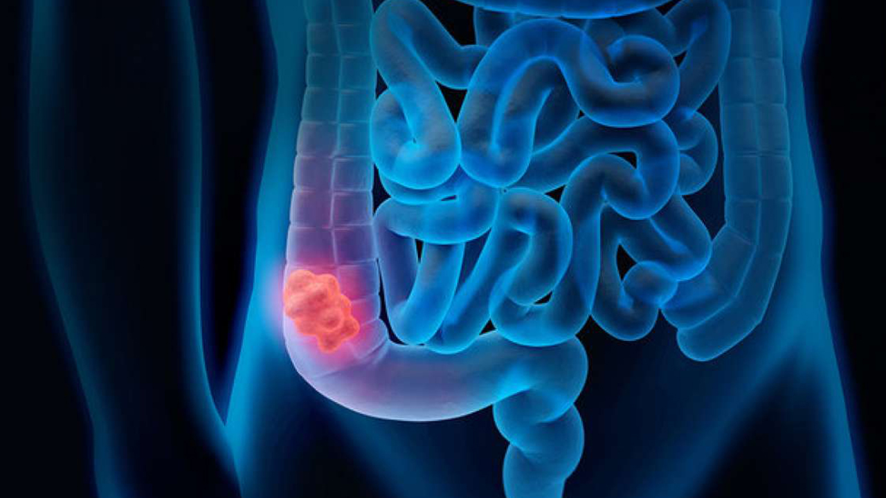 Screening cancro colon retto – Asl Roma 6: Mmg fondamentali per prevenire. L’obiettivo è intercettare le forme ai primissimi stadi